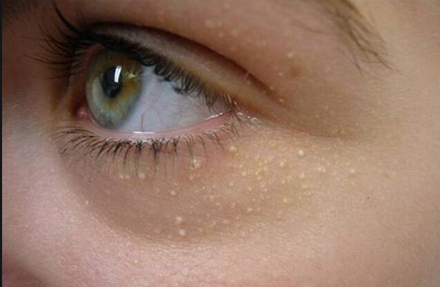 5個(gè)去除眼部脂肪粒的美容技巧