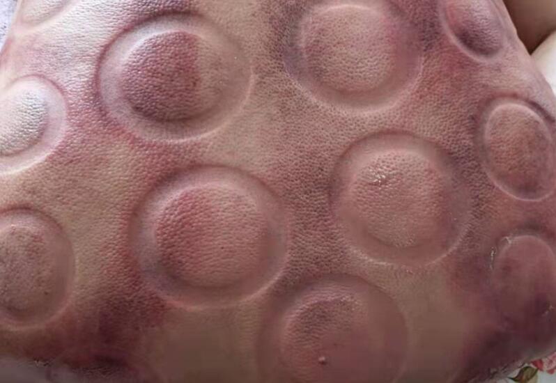 拔火罐有什么用？廣西美容職業(yè)培訓(xùn)學(xué)校演示給你看