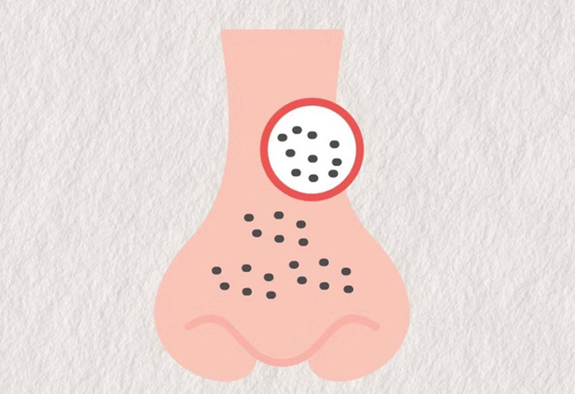 廣西皮膚管理師：面對嚴重的黑頭應(yīng)該怎么辦？